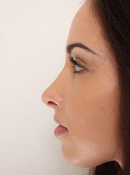 nosies formos korekcijos